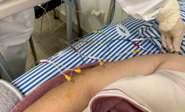 29岁脑出血患者的重生——针灸推拿+中药，3个月从瘫痪到独立行走